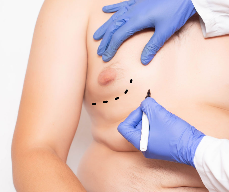 Rhinoplasty